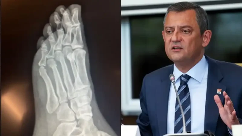 CHP Genel Başkanı Özgür Özel'in geçtiğimiz günlerde ayağı kırılmış, basında